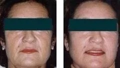 Lifting facciale – prima e dopo
